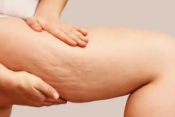 Image of woman showing leg with cellulite Sedgley Park