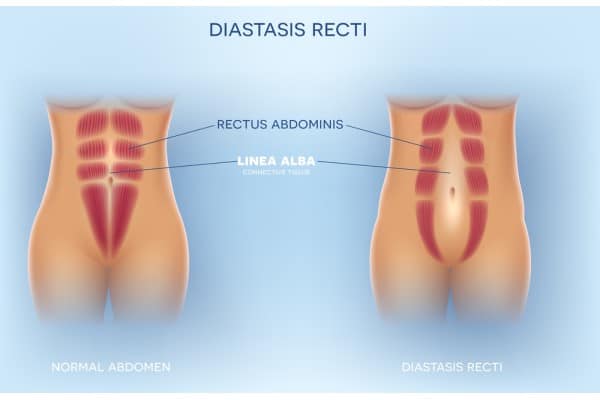 What Non-Surgical Options Are Available for Diastasis Recti Sedgley Park?