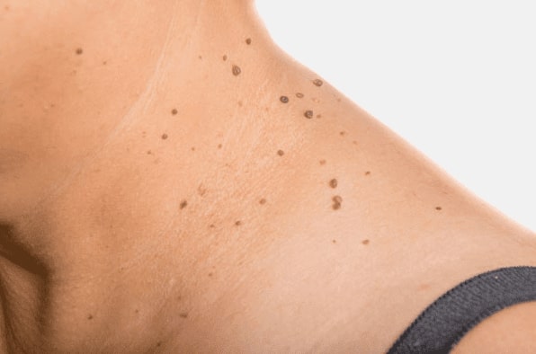 Are you looking for easy skin tag removal Sedgley Park - then contact Spire today!