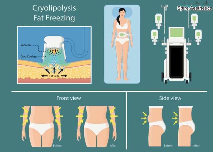 Image of diet and fat freezing combined for best results for Spire Aesthetics Sedgley Park