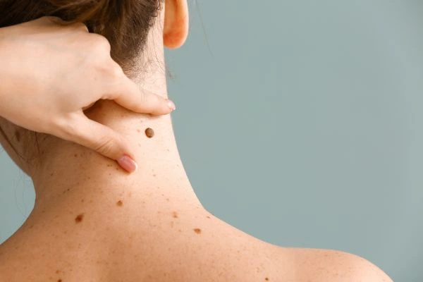 skin blemish removal Sedgley Park treatment