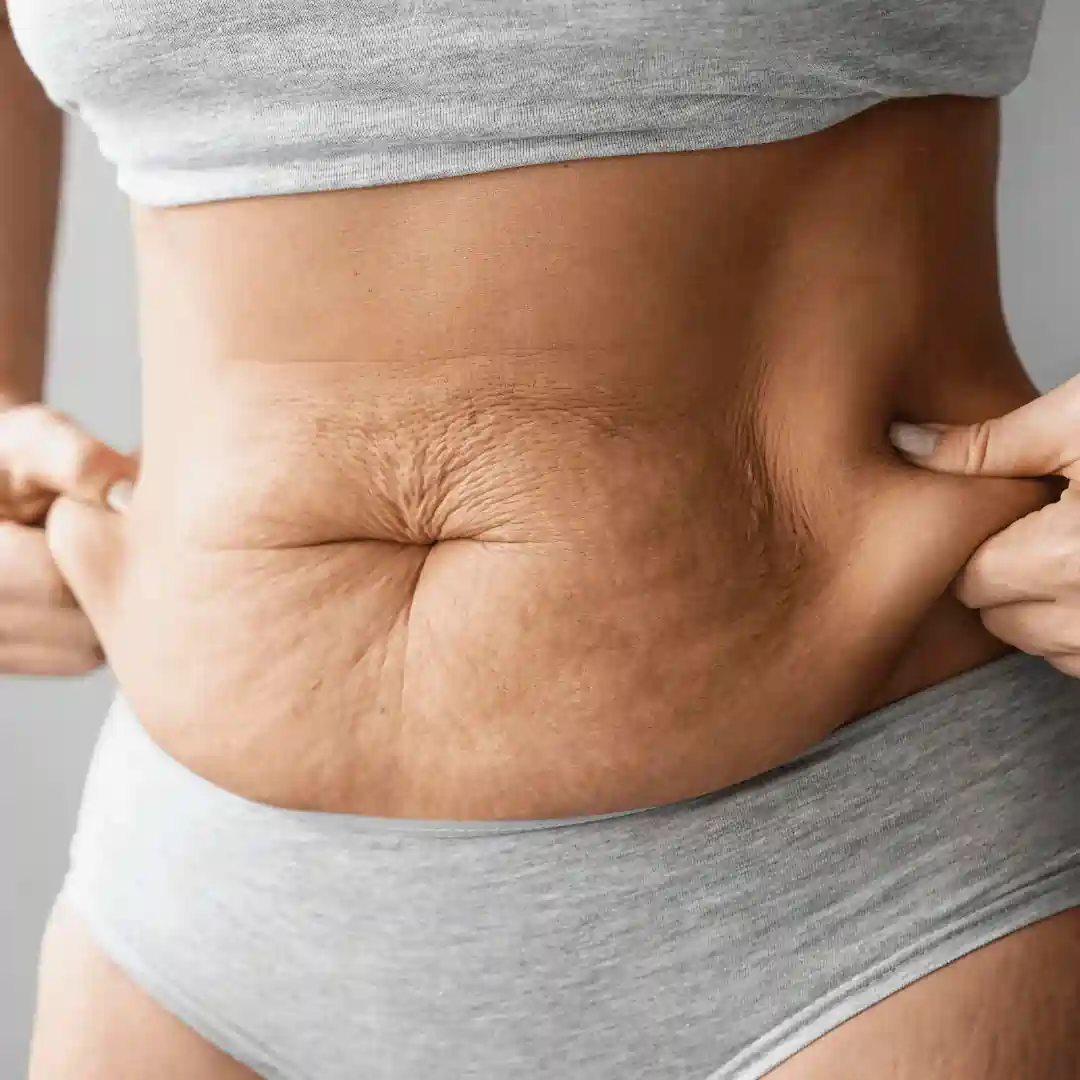 Is It Normal to Have Loose Skin After Pregnancy Sedgley Park?